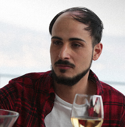 Before and after of Giuseppe with CNC hair prosthesis