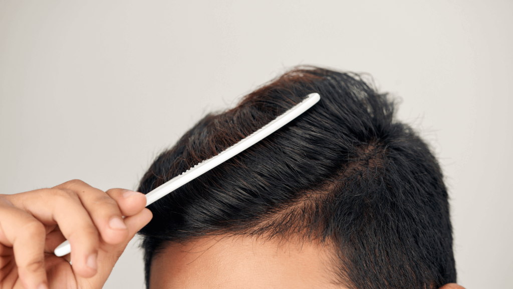 Men Hair Loss Treatment 01